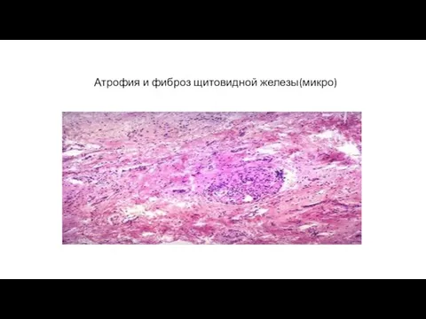 Атрофия и фиброз щитовидной железы(микро)