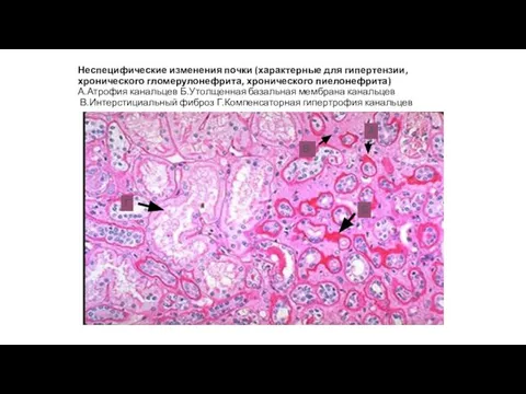 Неспецифические изменения почки (характерные для гипертензии, хронического гломерулонефрита, хронического пиелонефрита) А.Атрофия канальцев