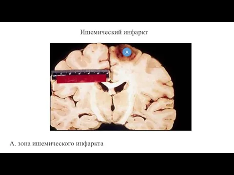 Ишемический инфаркт А. зона ишемического инфаркта А