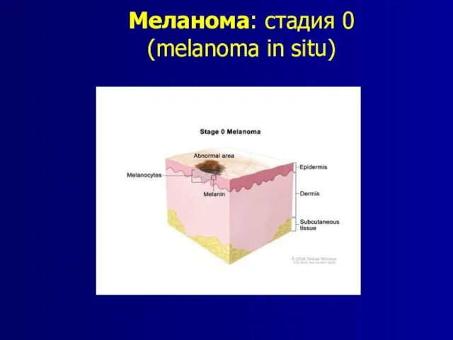 Меланома: стадия 0 (melanoma in situ)