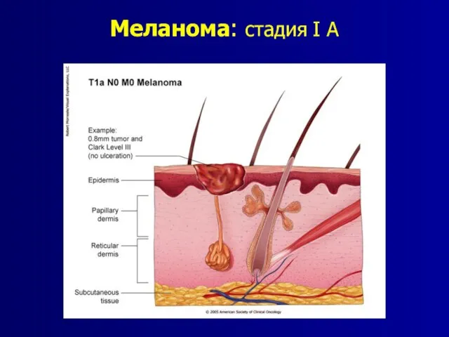 Меланома: стадия I A