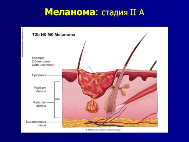 Меланома: стадия II A