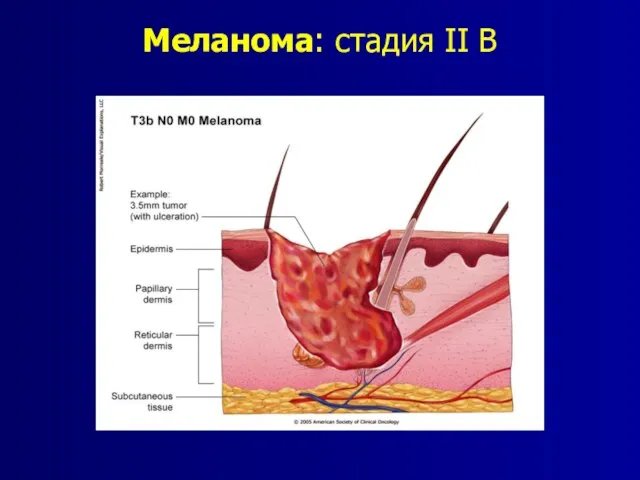 Меланома: стадия II B