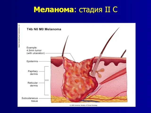 Меланома: стадия II C