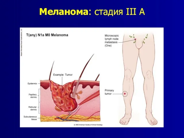 Меланома: стадия III A