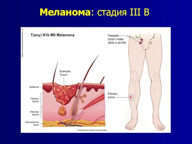 Меланома: стадия III B