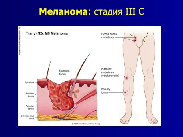 Меланома: стадия III C