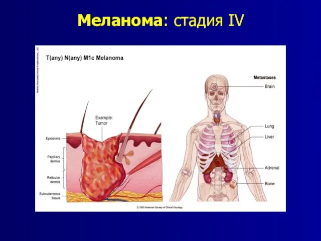 Меланома: стадия IV