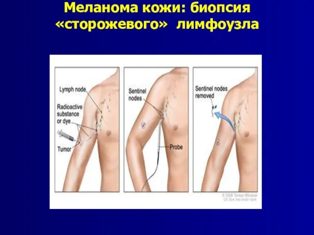 Меланома кожи: биопсия «сторожевого» лимфоузла