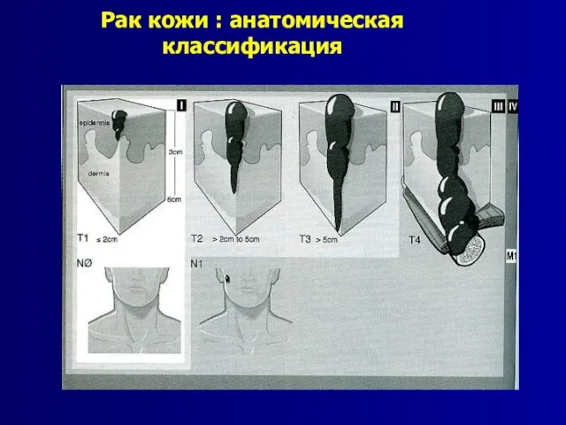 Рак кожи : анатомическая классификация