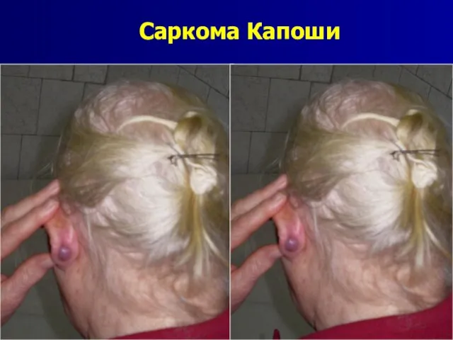 Саркома Капоши