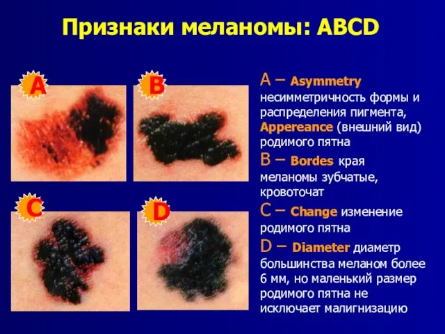 A – Asymmetry несимметричность формы и распределения пигмента, Appereance (внешний вид) родимого