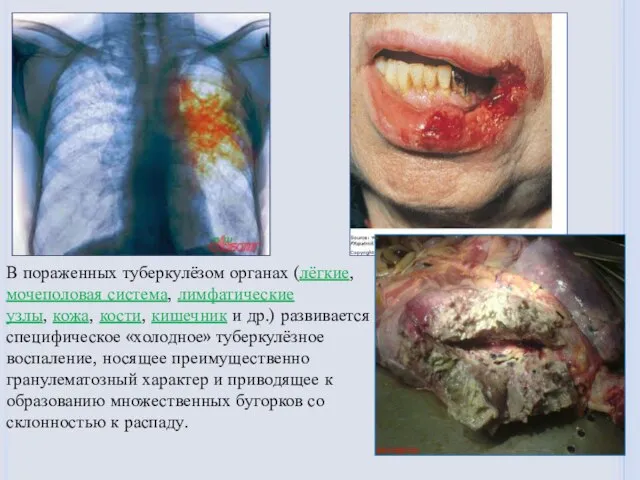 В пораженных туберкулёзом органах (лёгкие,мочеполовая система, лимфатические узлы, кожа, кости, кишечник и