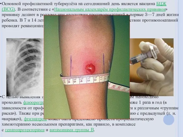 Основной профилактикой туберкулёза на сегодняшний день является вакцина БЦЖ (BCG). В соответствии