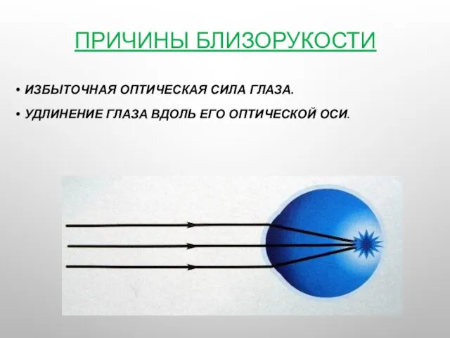 ПРИЧИНЫ БЛИЗОРУКОСТИ ИЗБЫТОЧНАЯ ОПТИЧЕСКАЯ СИЛА ГЛАЗА. УДЛИНЕНИЕ ГЛАЗА ВДОЛЬ ЕГО ОПТИЧЕСКОЙ ОСИ.