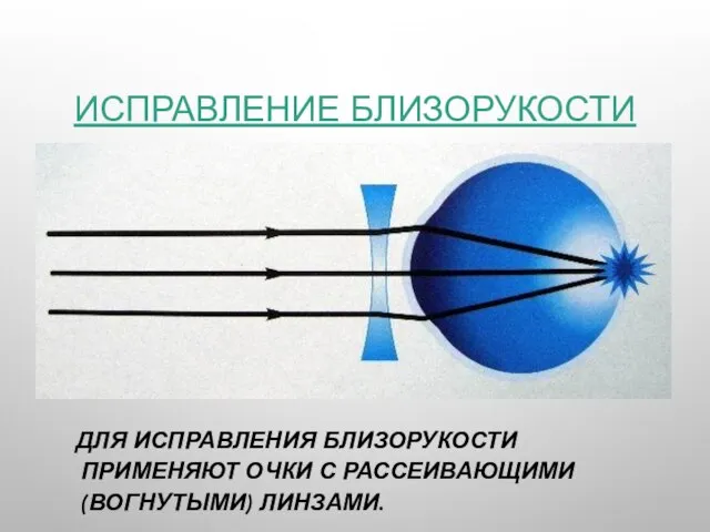 ИСПРАВЛЕНИЕ БЛИЗОРУКОСТИ ДЛЯ ИСПРАВЛЕНИЯ БЛИЗОРУКОСТИ ПРИМЕНЯЮТ ОЧКИ С РАССЕИВАЮЩИМИ (ВОГНУТЫМИ) ЛИНЗАМИ.