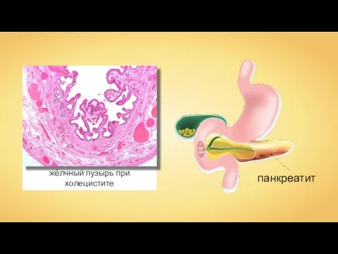 жёлчный пузырь при холецистите Nephron