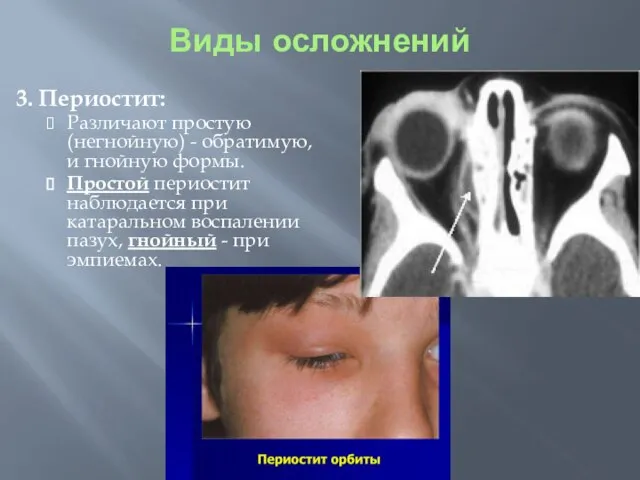 3. Периостит: Различают простую (негнойную) - обратимую, и гнойную формы. Простой периостит