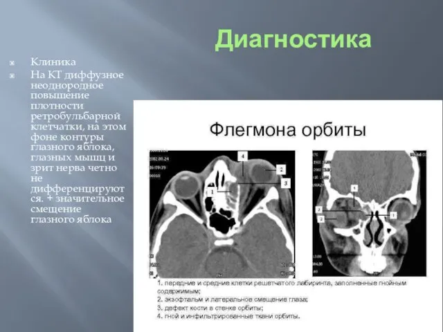 Диагностика Клиника На КТ диффузное неоднородное повышение плотности ретробульбарной клетчатки, на этом