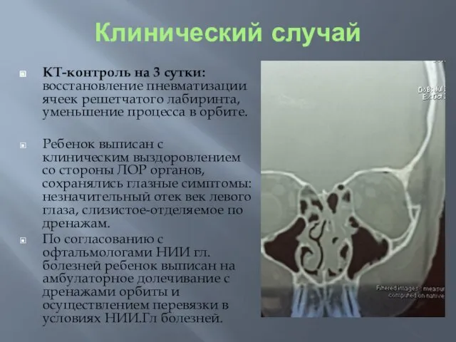 Клинический случай КТ-контроль на 3 сутки: восстановление пневматизации ячеек решетчатого лабиринта, уменьшение