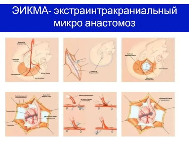 ЭИКМА- экстраинтракраниальный микро анастомоз