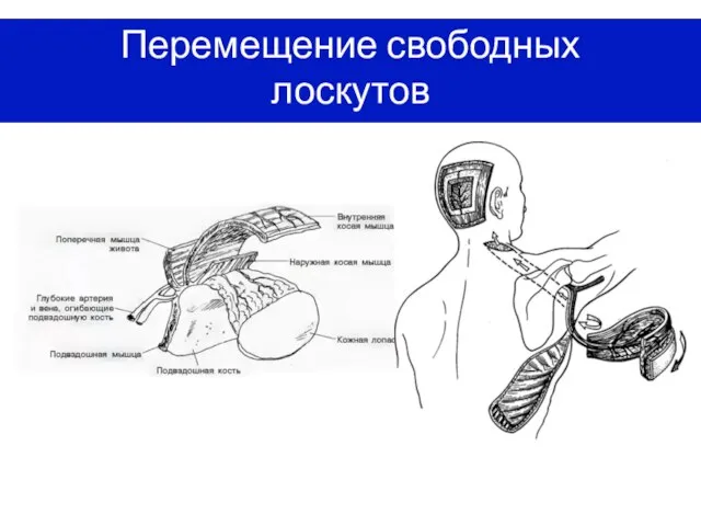 Перемещение свободных лоскутов