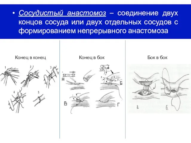 Сосудистый анастомоз – соединение двух концов сосуда или двух отдельных сосудов с