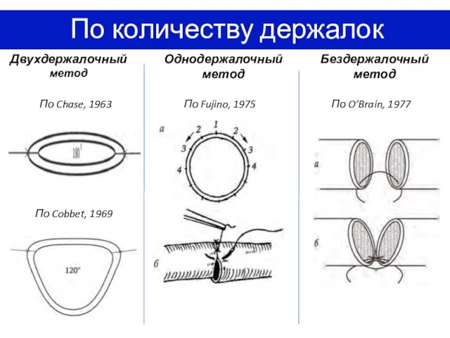 По количеству держалок Двухдержалочный метод По Chase, 1963 По Cobbet, 1969 Однодержалочный