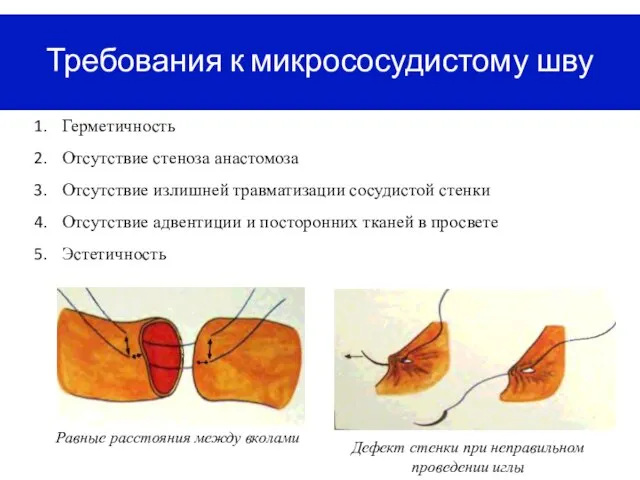 Требования к микрососудистому шву Герметичность Отсутствие стеноза анастомоза Отсутствие излишней травматизации сосудистой