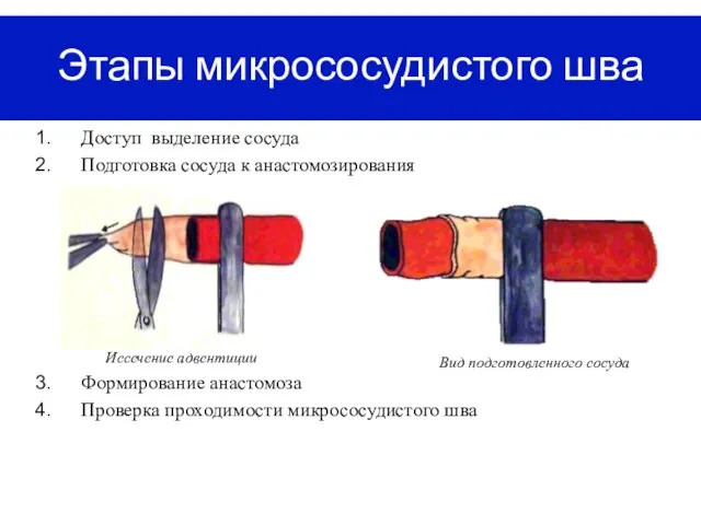 Этапы микрососудистого шва Доступ выделение сосуда Подготовка сосуда к анастомозирования Формирование анастомоза