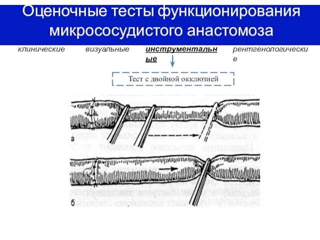 Оценочные тесты функционирования микрососудистого анастомоза клинические визуальные инструментальные рентгенологические Тест с двойной окклюзией