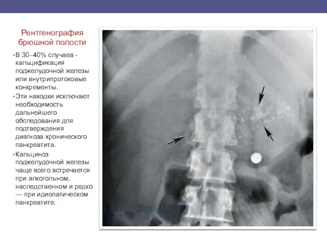 Рентгенография брюшной полости В 30–40% случаев - кальцификация поджелудочной железы или внутрипротоковые