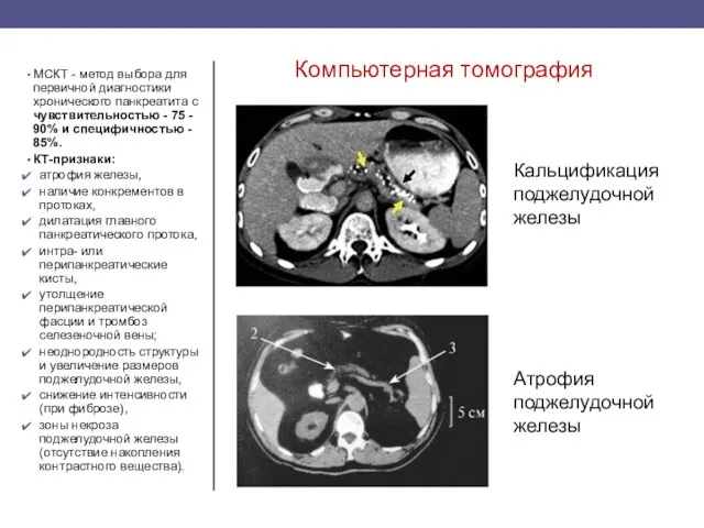 Компьютерная томография МСКТ - метод выбора для первичной диагностики хронического панкреатита с