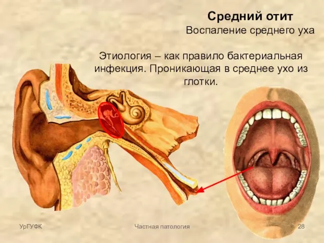 Средний отит Воспаление среднего уха Этиология – как правило бактериальная инфекция. Проникающая