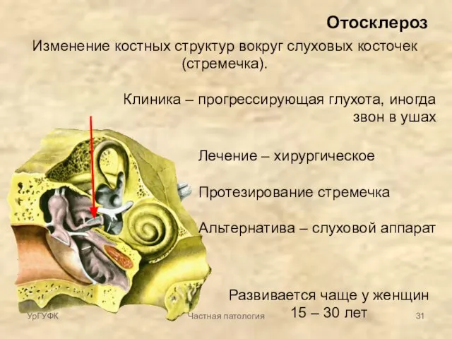 Отосклероз Изменение костных структур вокруг слуховых косточек (стремечка). Лечение – хирургическое Протезирование