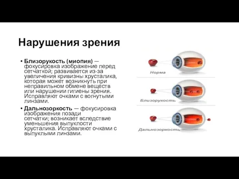 Нарушения зрения Близорукость (миопия) — фокусировка изображение перед сетчаткой; развивается из-за увеличения