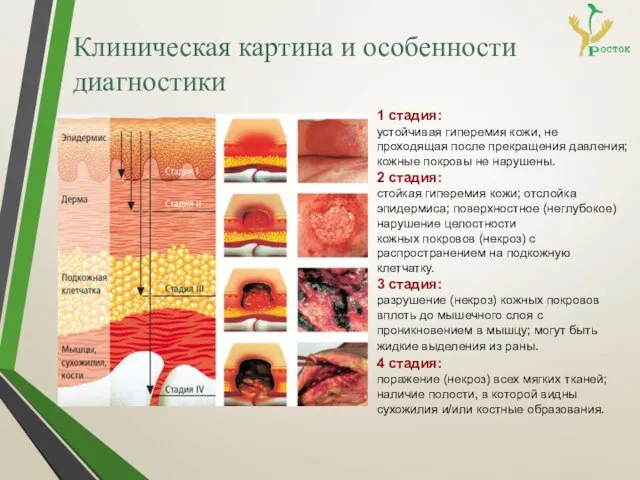 Клиническая картина и особенности диагностики 1 стадия: устойчивая гиперемия кожи, не проходящая