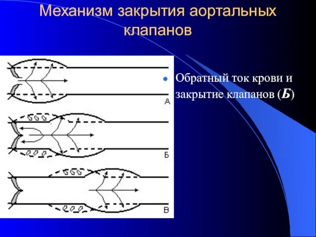 Механизм закрытия аортальных клапанов Обратный ток крови и закрытие клапанов (Б)