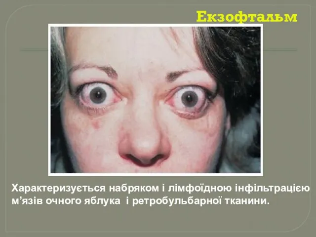 Екзофтальм Характеризується набряком і лімфоїдною інфільтрацією м’язів очного яблука і ретробульбарної тканини.