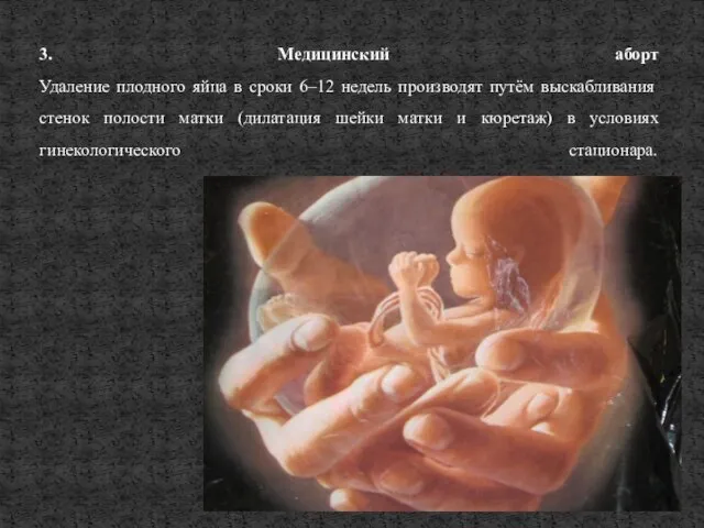 3. Медицинский аборт Удаление плодного яйца в сроки 6–12 недель производят путём