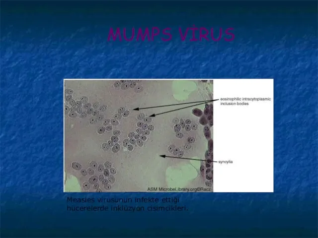 MUMPS VİRUS Measles virusunun infekte ettiği hücerelerde inklüzyon cisimcikleri.