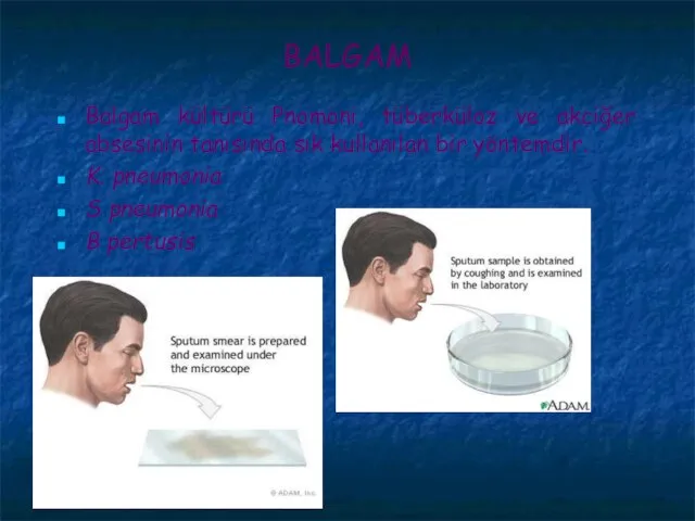 BALGAM Balgam kültürü Pnomoni, tüberküloz ve akciğer absesinin tanısında sık kullanılan bir