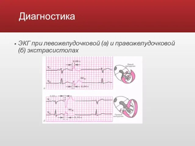 Диагностика ЭКГ при левожелудочковой (а) и правожелудочковой (б) экстрасистолах