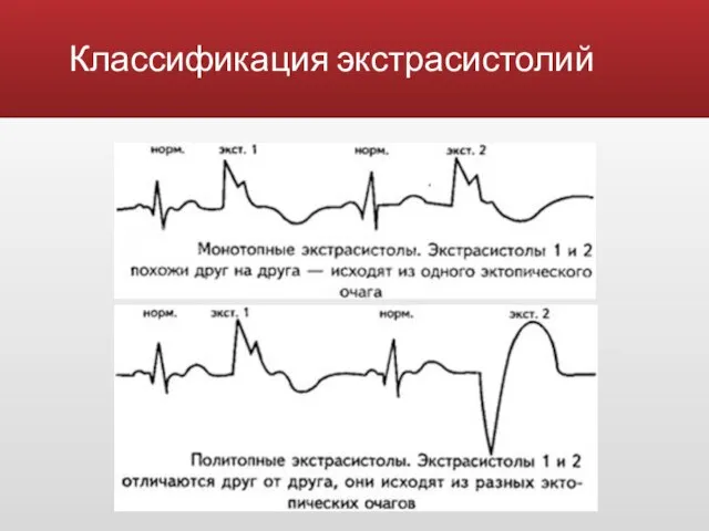 Классификация экстрасистолий