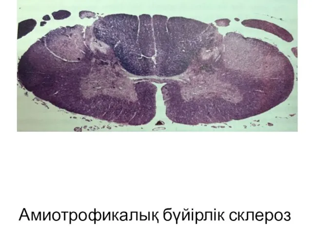 Амиотрофикалық бүйірлік склероз