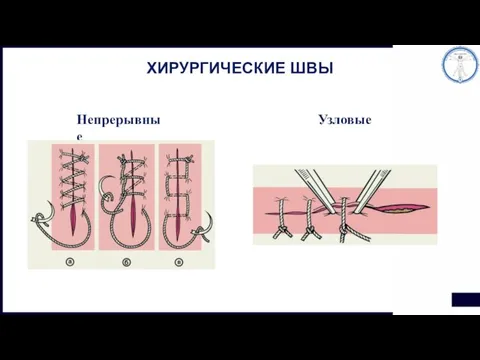 ХИРУРГИЧЕСКИЕ ШВЫ Непрерывные Узловые