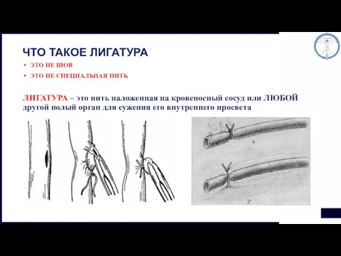 ЧТО ТАКОЕ ЛИГАТУРА ЭТО НЕ ШОВ ЭТО НЕ СПЕЦИАЛЬНАЯ НИТЬ ЛИГАТУРА –