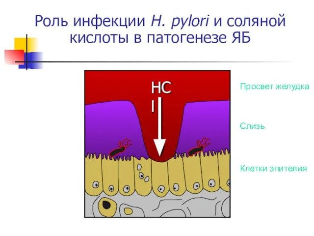 Роль инфекции H. pylori и соляной кислоты в патогенезе ЯБ Клетки эпителия Слизь Просвет желудка HCl