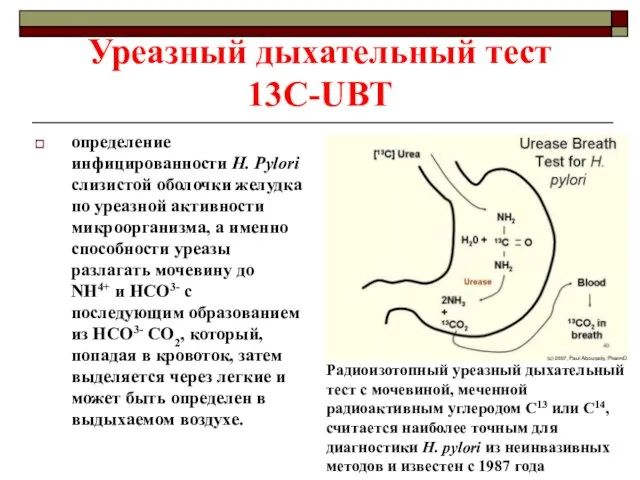 Уреазный дыхательный тест 13C-UBT определение инфицированности H. Pylori слизистой оболочки желудка по