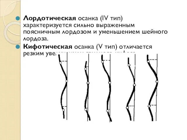 Лордотическая осанка (IV тип) характеризуется сильно выраженным поясничным лордозом и уменьшением шейного